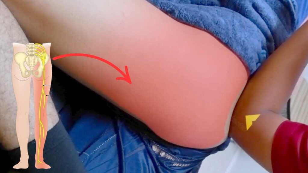 Terapi Pengobatan Sindrom Piriformis