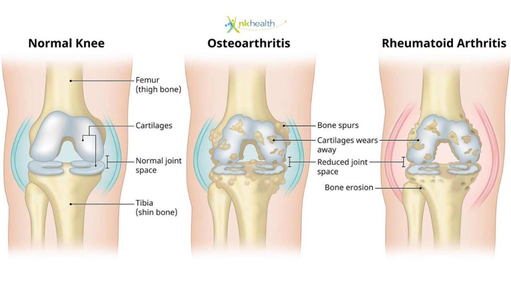 Gejala Osteoarthritis Lutut