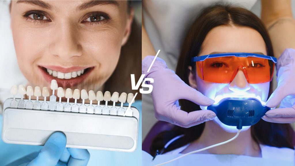 Lebih Baik Bleaching atau Veneer