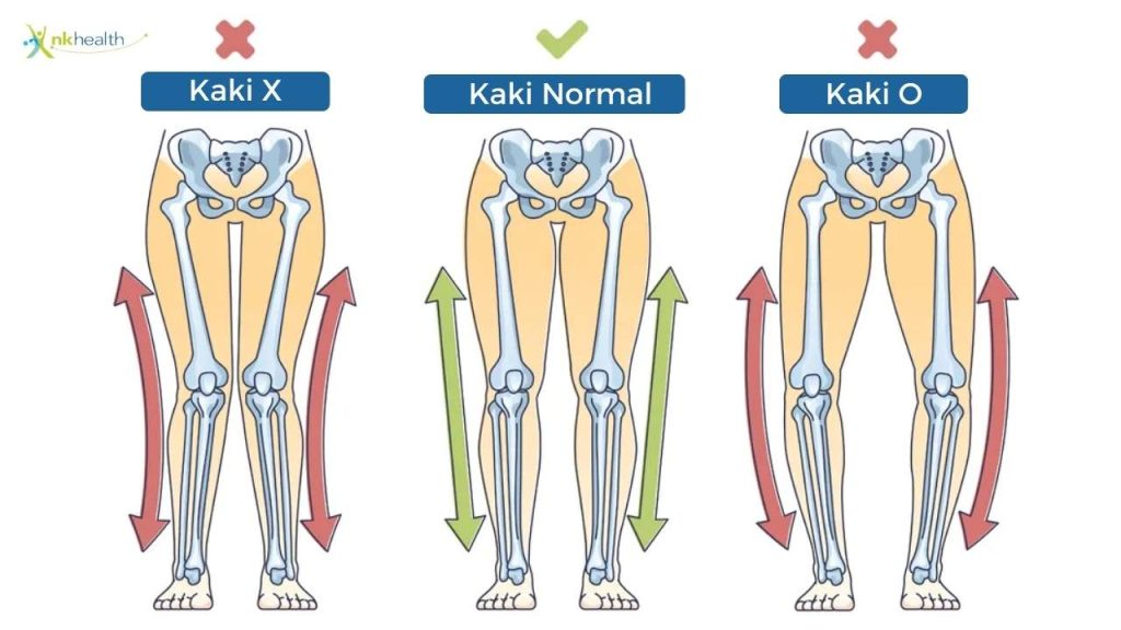 Apakah Kaki O Pada Orang Dewasa Bisa Sembuh?