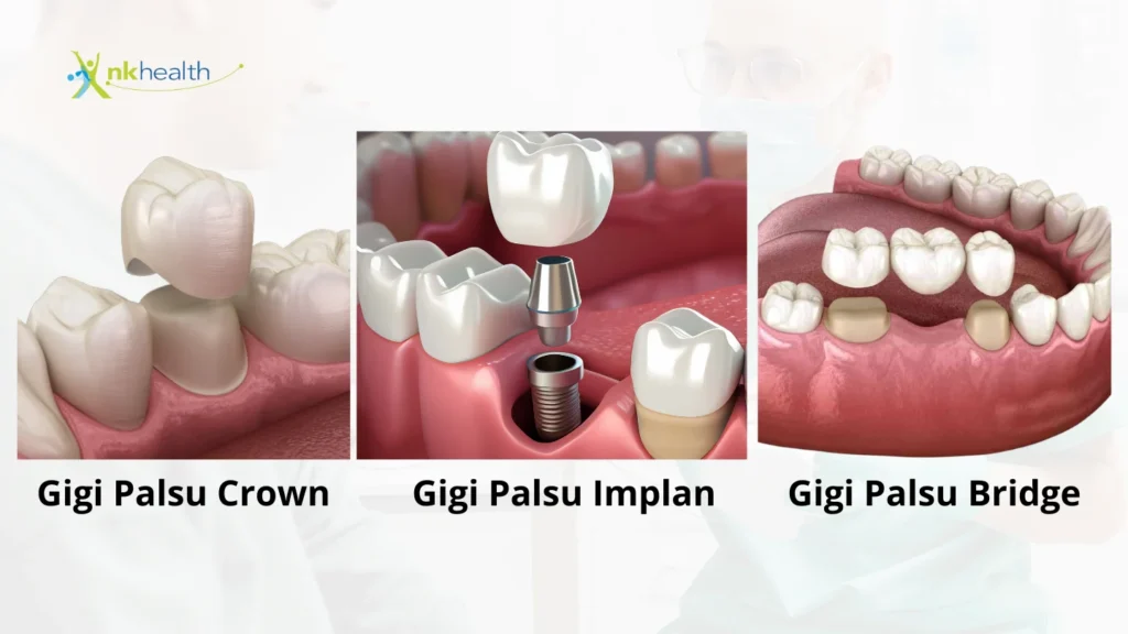 Jenis - Jenis Gigi Palsu Permanen
