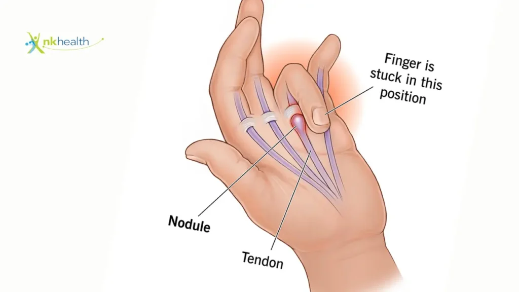 Apakah Penyakit Trigger Finger Bisa Sembuh Sendiri?