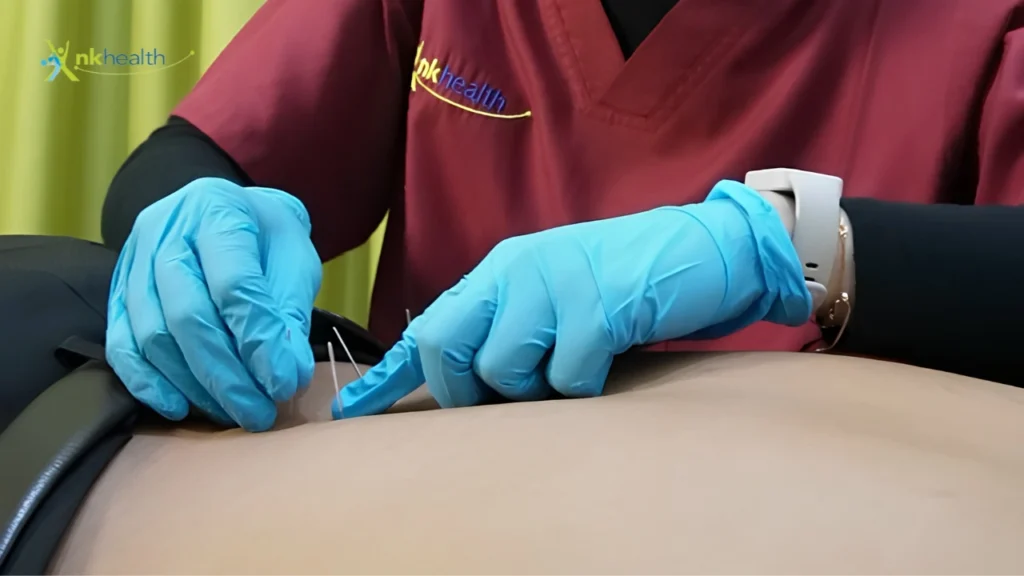 Dry Needling Fisioterapi