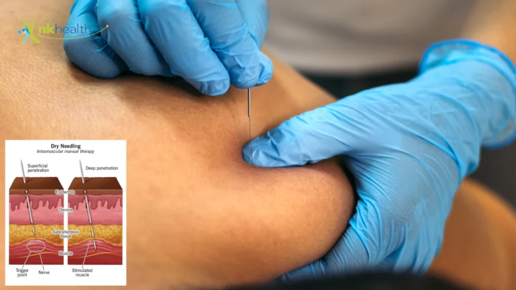 Terapi Dry Needling di Bintaro